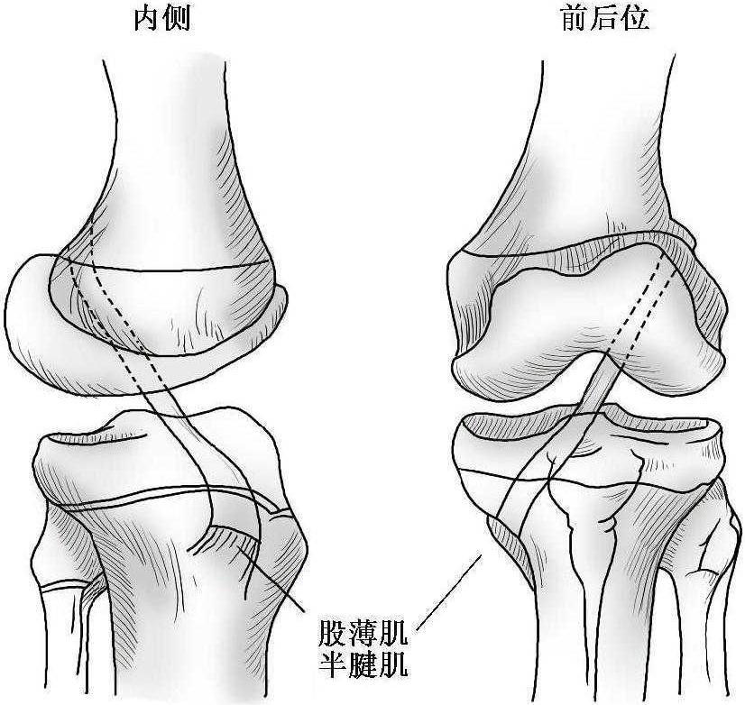 兒童前交叉韌帶損傷